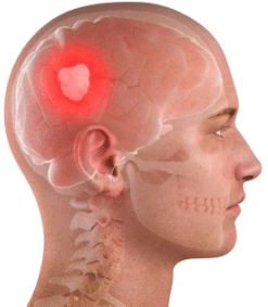 symptoms of a brain tumor